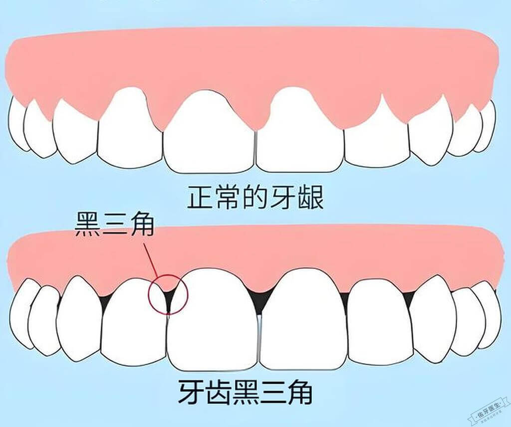 牙齿黑三角与正常牙龈对比图