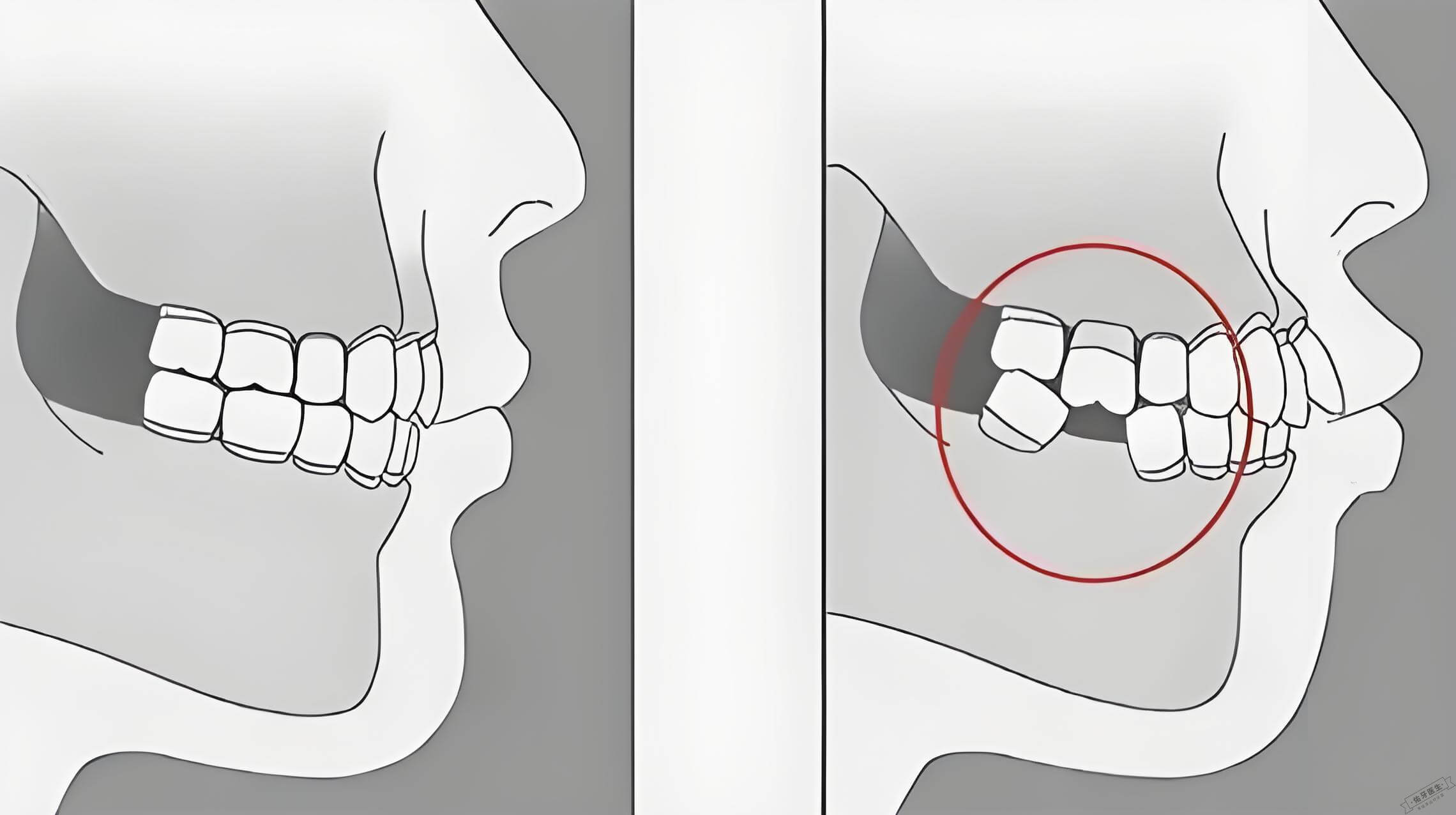 牙齿缺失影响图