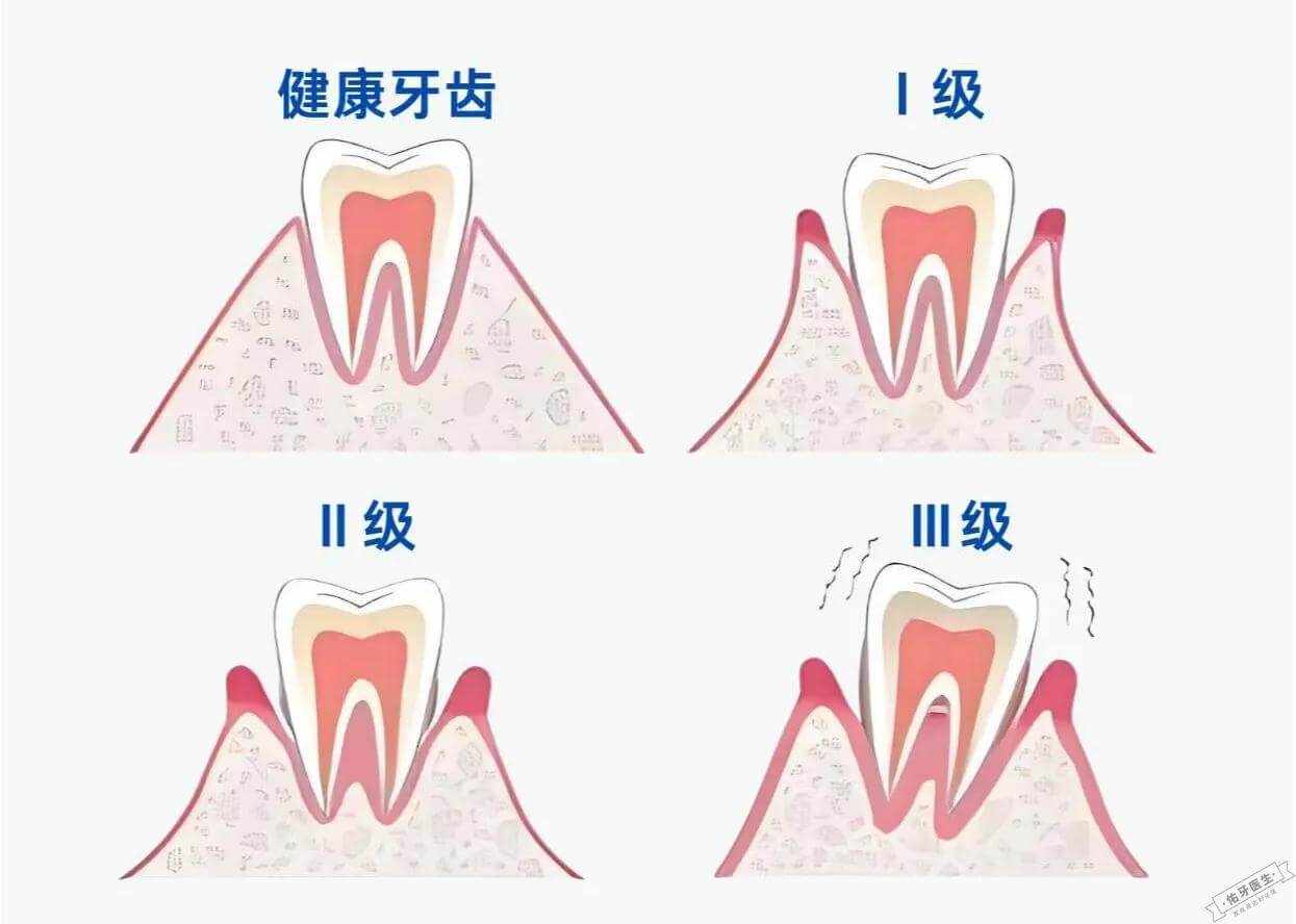 牙齿松动等级对比图