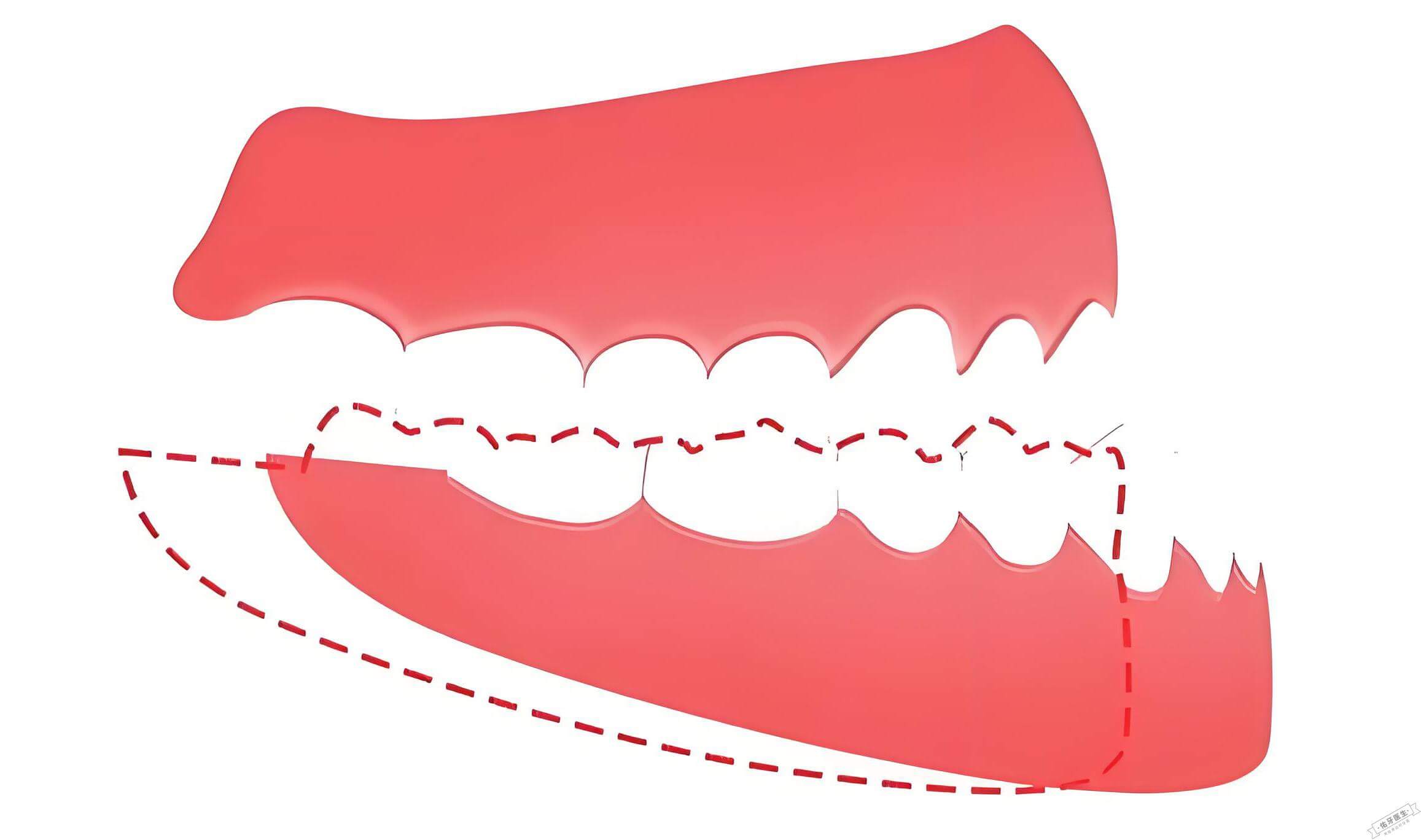 牙齿咬合不正示意图