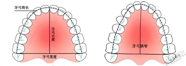 牙弓狭窄对比图