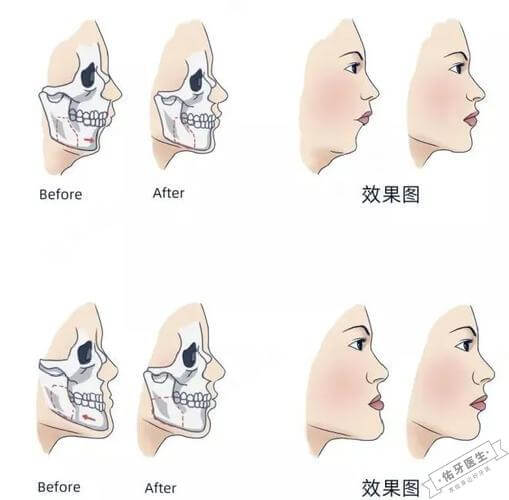 牙颌畸形示意图