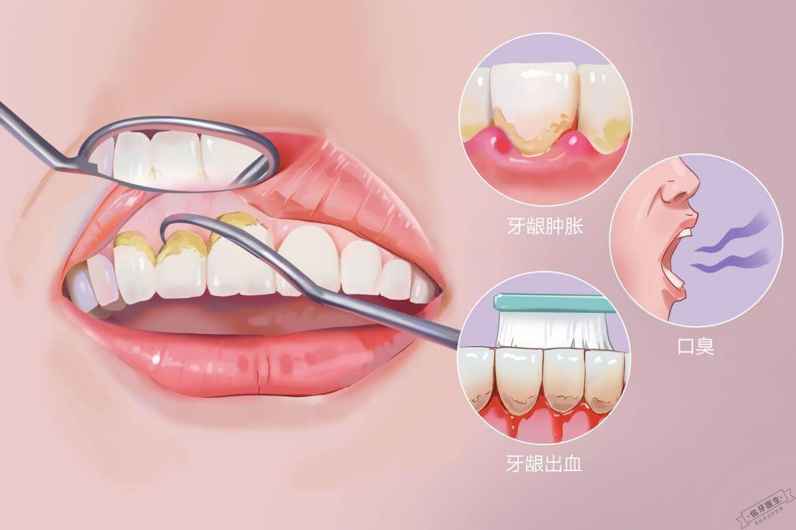 牙结石典型症状和影响