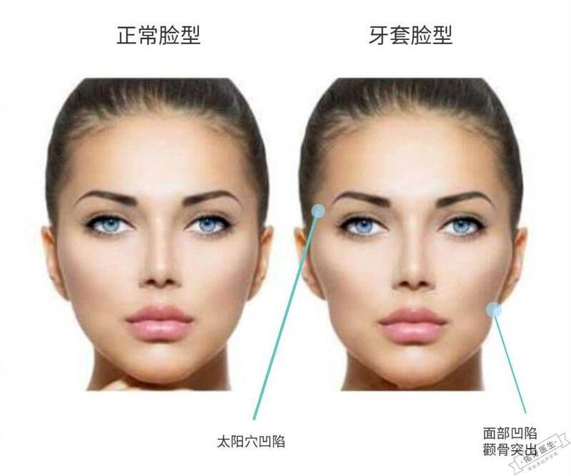 正常脸型与牙套脸型对比