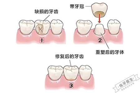牙体缺损的修复方法之牙冠