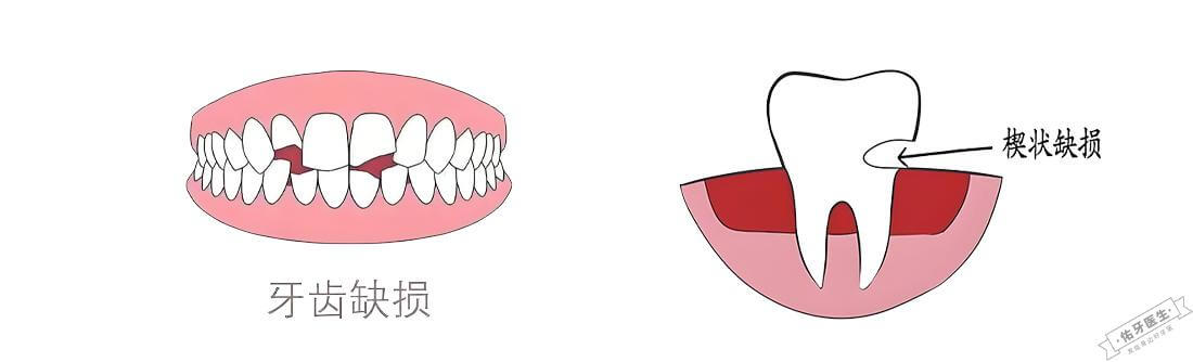 牙体缺损主要场景