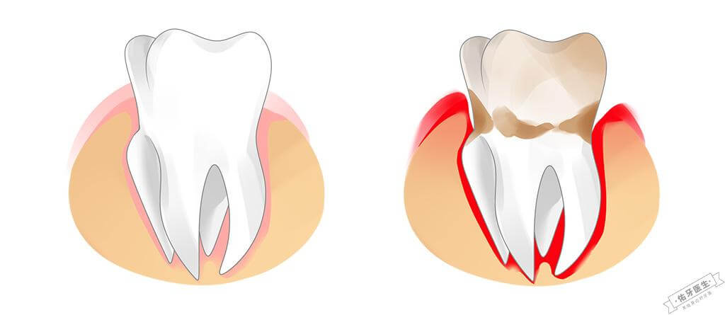 牙龈出血与正常牙龈对比图