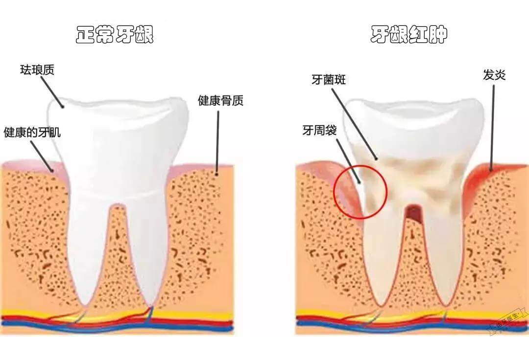 牙龈红肿与正常牙龈对比图