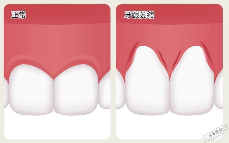 牙龈萎缩与正常牙龈对比图