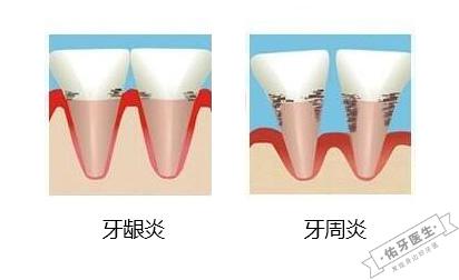 牙龈炎与牙周炎
