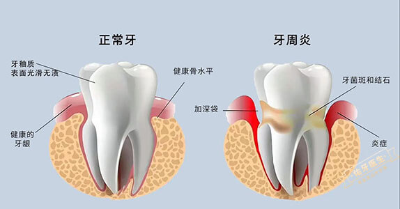 牙周炎与正常牙对比图