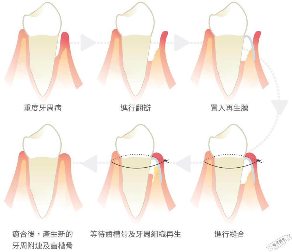 牙周再生术过程