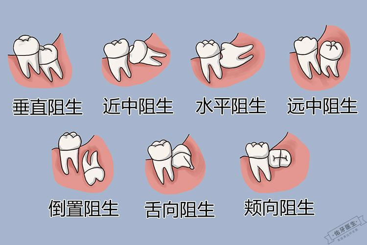 阻生智齿的常见类型