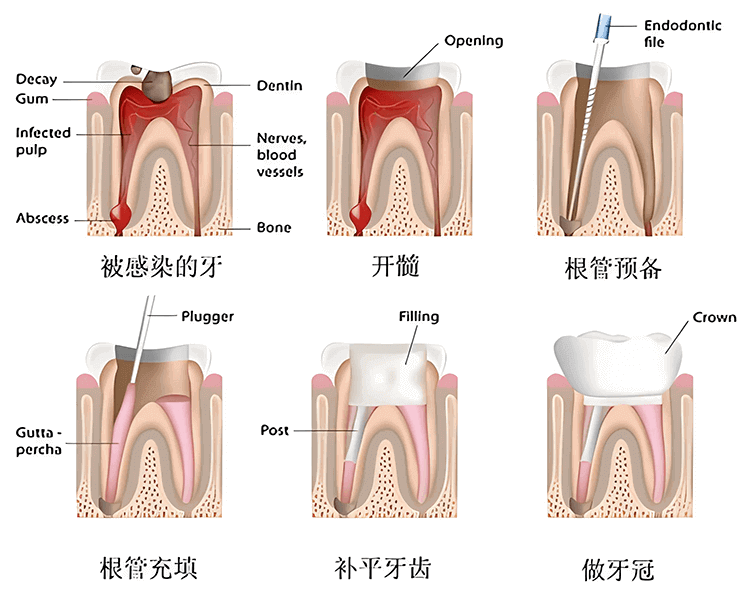 根管治疗的具体流程
